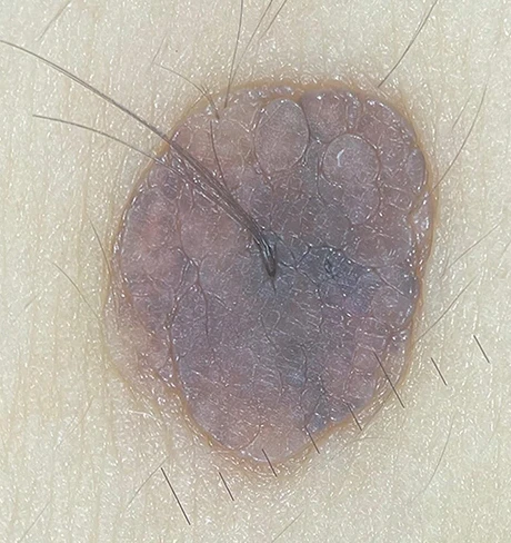A mole under non-polarized light, surface glare on top