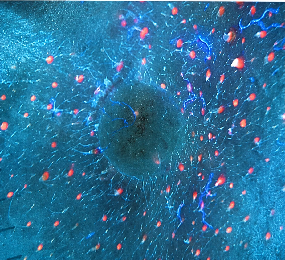 The same lesion under 365nm ultraviolet light