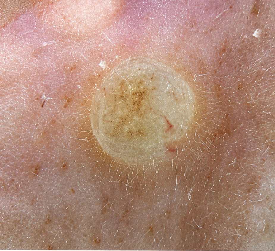 A skin lesion in visible light